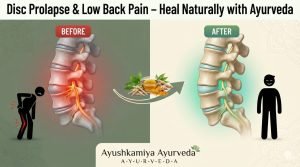 Back Pain Due to Disc Prolapse: Causes, Symptoms and Ayurvedic Approach